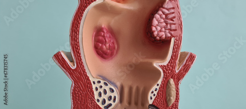 Anatomical model of rectum with hemorrhoids closeup photo