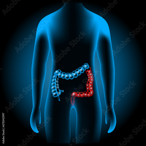 Inflammatory bowel disease