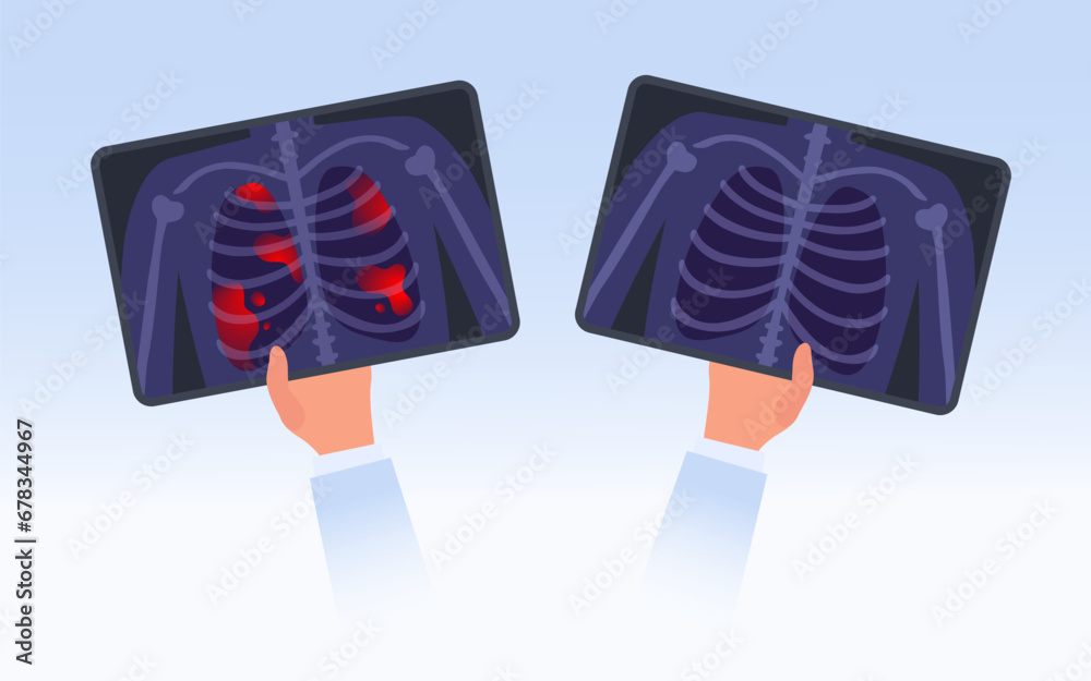 Xray film of examine the lungs concept. Doctor examines CT scan to
