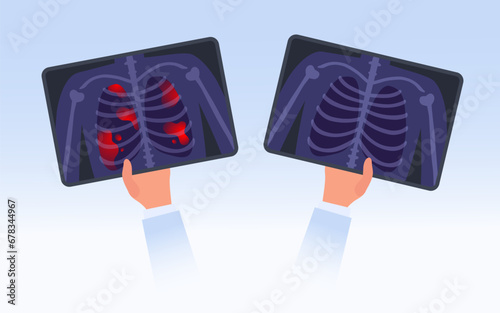 X-ray film of examine the lungs concept. Doctor examines CT scan to detect reason of chest pain, checking lungs disease. Two hands holding Xray image of healthy and unhealthy patient`s lungs vector