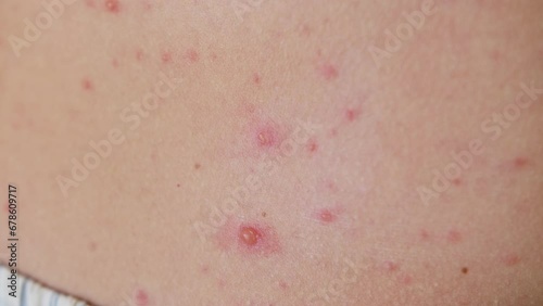 The classic symptom of chickenpox is a rash that turns into itchy, fluid-filled blisters.