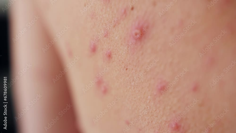 Close-up of chicken pox on the back of an adult person. The classic symptom of chickenpox is a rash that turns into itchy, fluid-filled blisters. Close-up of chicken pox on the back of an adult person. The classic symptom of chickenpox is a rash that turns into itchy, fluid-filled blisters.