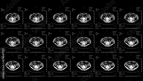 CT scan. 3 to 6 MRI x ray Scan.Medical HUD Analyzing abdominal appendicitis diagnosis. Technological Interface. Healthcare. 2D 