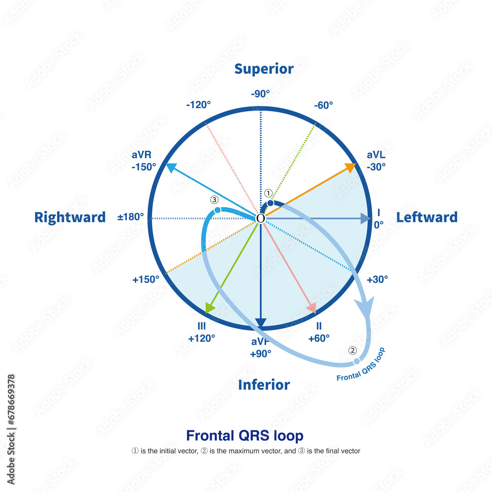 During ventricular depolarization, a spatial QRS loop is generated ...