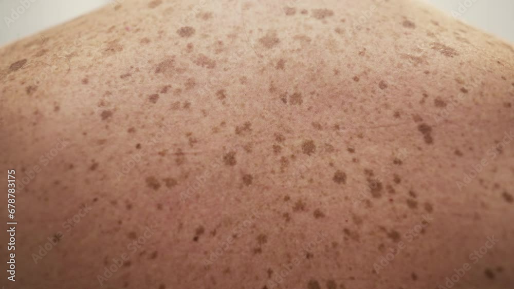Pigmented skin. Spots on a man's back Pigmented skin. Spots on a man's back