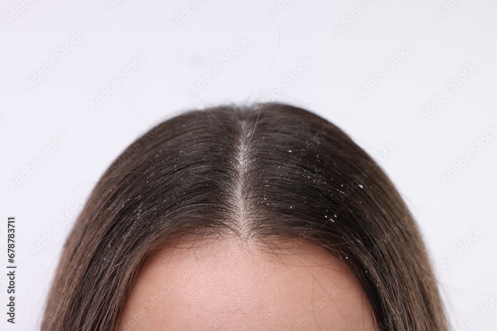 Woman with dandruff problem on white background, closeup Woman with dandruff problem on white background, closeup