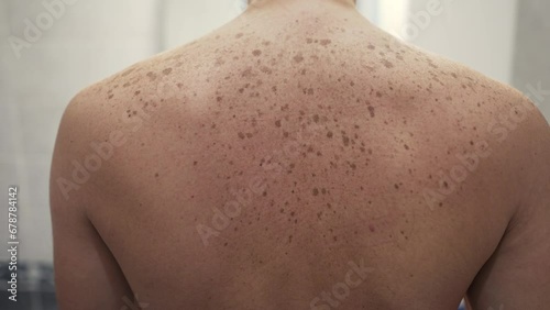 Pigmented skin on a man's back photo