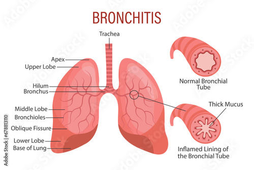 Bronchitis, a lung disease. Healthcare. Medical infographic banner, illustration, vector photo