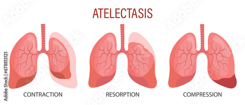 Atelectasis, a lung disease. Contraction, resorption, compression. Medical infographic banner, illustration, vector
