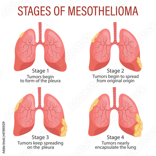 Stages of mesothelioma, lung disease. Healthcare. Medical infographic banner, illustration, vector photo