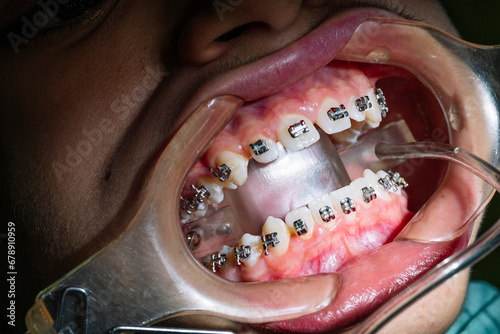 Teenage at the dental clinic putting bracket to correct teeth