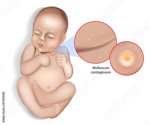 Molluscum contagiosum virus infection. Water warts. Molluscum contagiosum on the skin of an infant photo