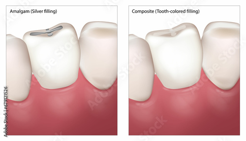 Dental Filling Procedure. Amalgam Silver filling and Composite Tooth colored filling. Dental restorations photo