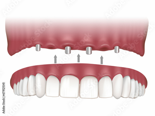 Maxillary Implant Supported Fixed Prosthesis. Maxillary overdentures supported by four implants. Procedure on the All in Four dental implants.