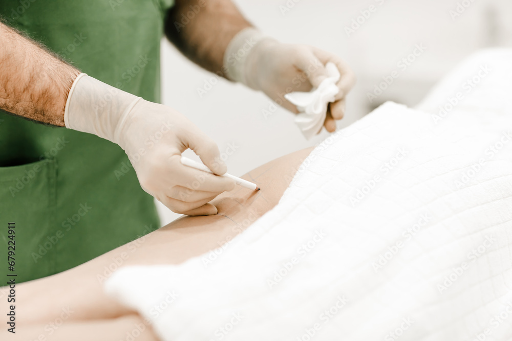 Close-up of an aesthetic doctor's hands with a pen, marking treatment areas on a woman's legs, showcasing precise medical planning Close-up of an aesthetic doctor's hands with a pen, marking treatment areas on a woman's legs, showcasing precise medical planning