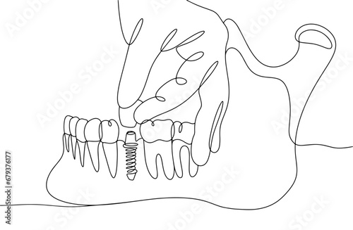 Jaw. Tooth. Prosthesis. Implant. One line