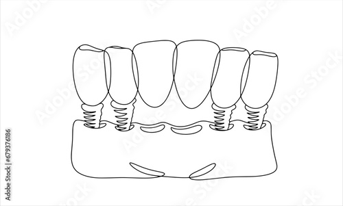 6 teeth. Dental bridge. One line