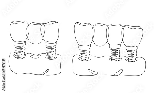 Dental bridge. Several teeth. One line