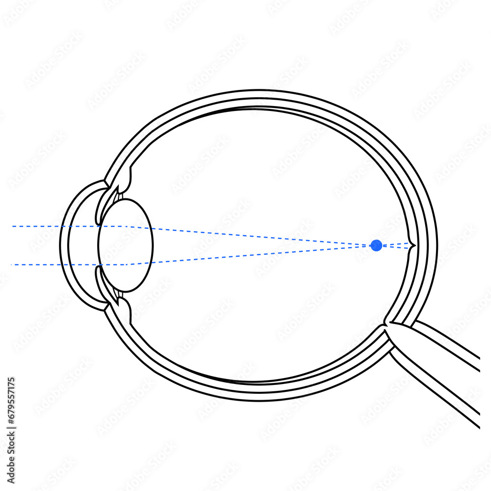 軸性近視の眼球のイラスト 軸性近視の眼球のイラスト