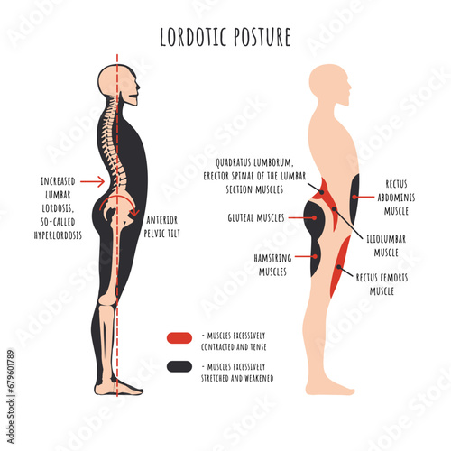 Posture disorders infographics. Lordotic posture. Side view shows hyperlordosis deformation, spine curvature, pelvis rotation, stretched and weakened, shortened and tens muscles. Vector illustration.