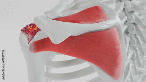 3D Rendering of Calcific Tendonitis in the Shoulder photo