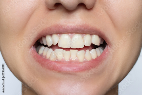 Young woman's smile before teeth straightening and whitening. Upper and lower jaw with crooked teeth before installation of veneers or braces. Close-up. Patient at a dental orthodontic clinic.