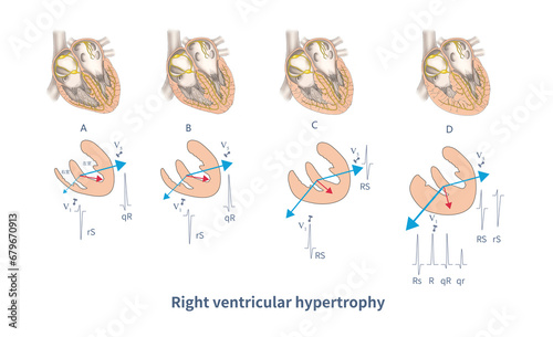 Fotografie During ventricular depolarization, varying degrees of right ventricular hypertrophy and left ventricular confrontation produce different forms of right ventricular hypertrophy ECG
