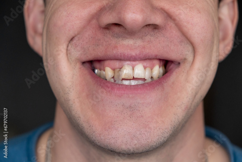 A man's crooked teeth. Young man showing crooked growing teeth. The man needs to go to the dentist to install braces. photo