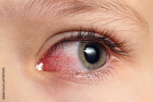 Closeup irritated infected red bloodshot eyes, conjunctivitis photo