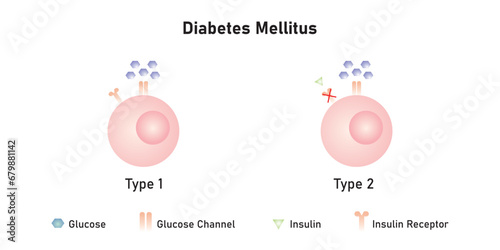 Diabetes Mellitus (Type 1 and Type 2 Diabetes) Scientific Design. Vector Illustration. photo