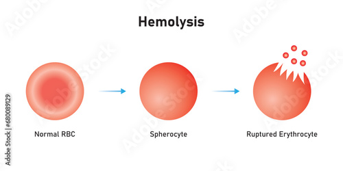 Hemolysis Process. The RBC Destruction Scientific Design. Vector Illustration.