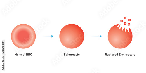 Hemolysis Process. The RBC Destruction Scientific Design. Vector Illustration.