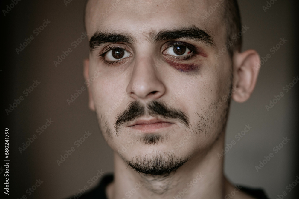Fototapeta premium Injured young man with bruises on his face
