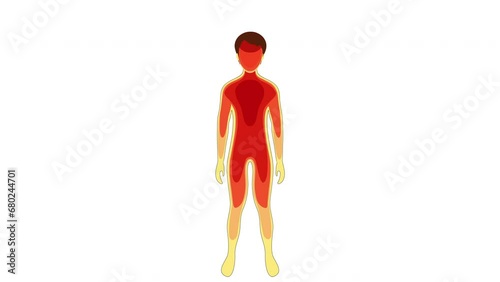 Hyperthermia. Changes in a  Body temperature during heat stroke. A thermal image showing temperature variation in a human body. failed thermoregulation. 2d 