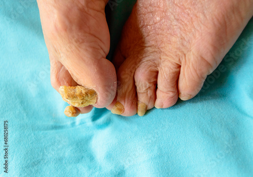 Onychomycosis, also known as tinea unguium, is a fungal infection of the nail. photo