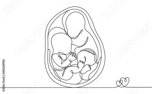 Pregnancy. Twins. Dizygotic. One line