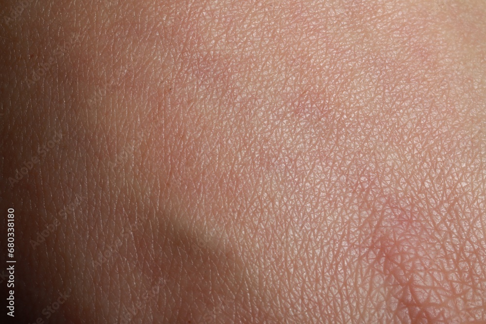 Fototapeta premium Closeup view of dry human skin as background