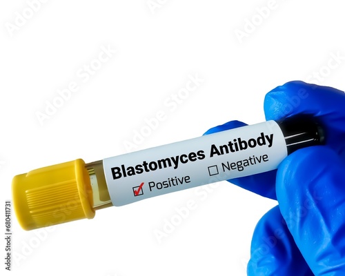 Blastomycosis is an infection caused by a fungus called Blastomyces. Blastomytes Antibody test photo