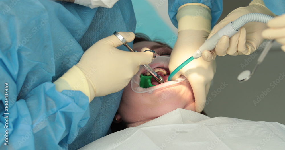 Dental treatment close-up. A dentist performs a dental procedure. Dentist's hands at work. Oral cavity in the process of treatment at the dentist. Dental treatment close-up. A dentist performs a dental procedure. Dentist's hands at work. Oral cavity in the process of treatment at the dentist.