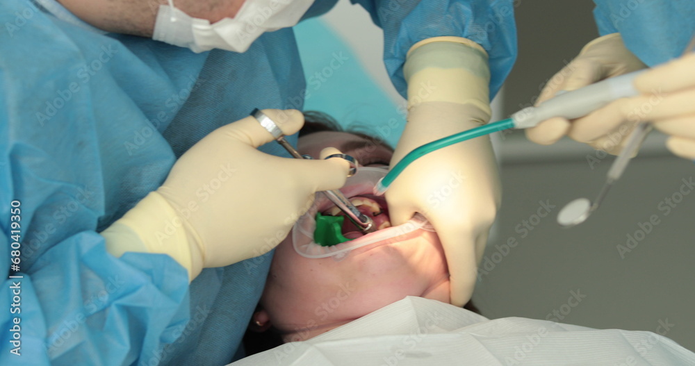 Dental treatment close-up. A dentist performs a dental procedure. Dentist's hands at work. Oral cavity in the process of treatment at the dentist. Dental treatment close-up. A dentist performs a dental procedure. Dentist's hands at work. Oral cavity in the process of treatment at the dentist.