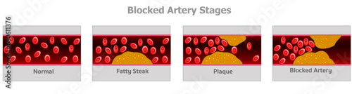 Blocked artery, blood vessels stages. Fatty steak, plaque. flow red cells pressure. cardiac bypass. Warning signs of clogged arteries. Coronary heart disease. Illustration vector