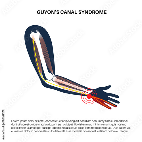 Guyons canal syndrome