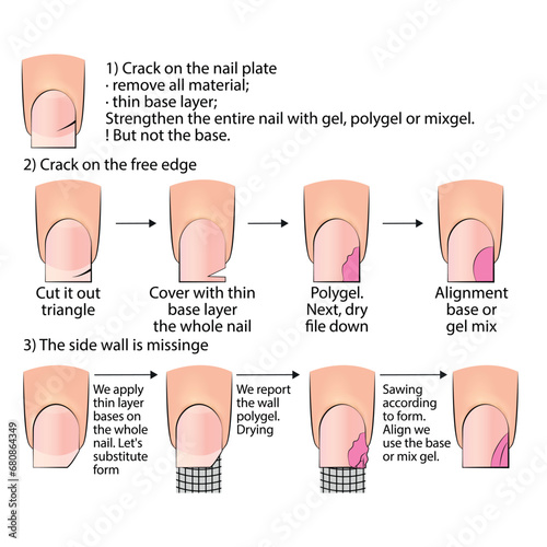 Illustration with the stages of manicure technology with eliminating cracks using polygel. Educational material