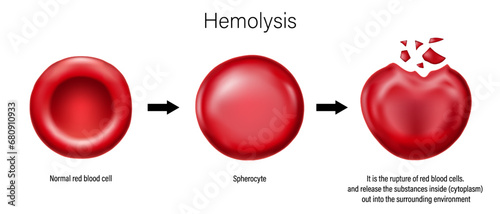 Hemolysis of red blood cell. Normal red blood cell, spherocyte, and rupturing of erythrocyte. 