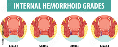 Anatomy of Human Internal Hemorrhoid in Different Grades