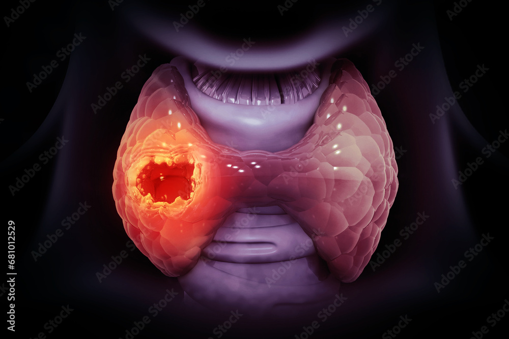 Thyroid gland cancer. showing thyroid gland with tumor. 3d illustration - obrazy, fototapety, plakaty 