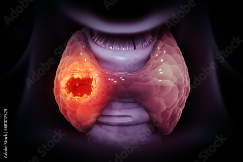 Thyroid gland cancer. showing thyroid gland with tumor. 3d illustration photo