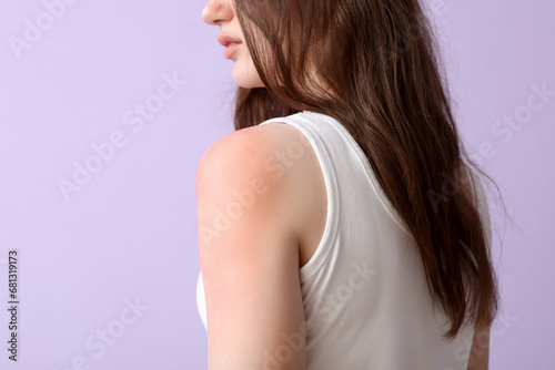 Allergic young woman with sunburned skin on lilac background, closeup