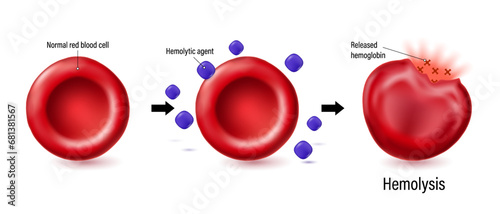 Hemolysis vector. The process of red blood cell destruction. Normal red blood cell with hemolytic agent and rupturing of erythrocyte.  photo