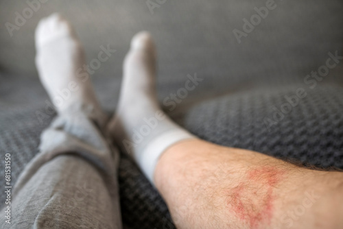 Low section of man with Lyme disease on leg at home photo